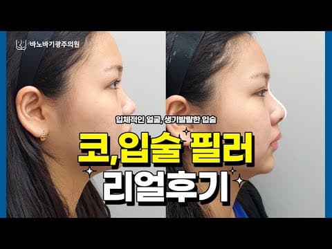 코, 입술 필러 리얼후기